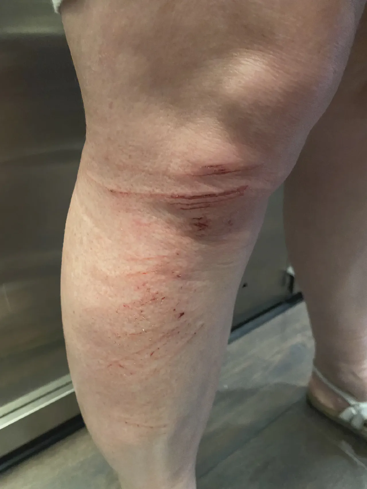 Danielle&rsquo;s gravel rash
